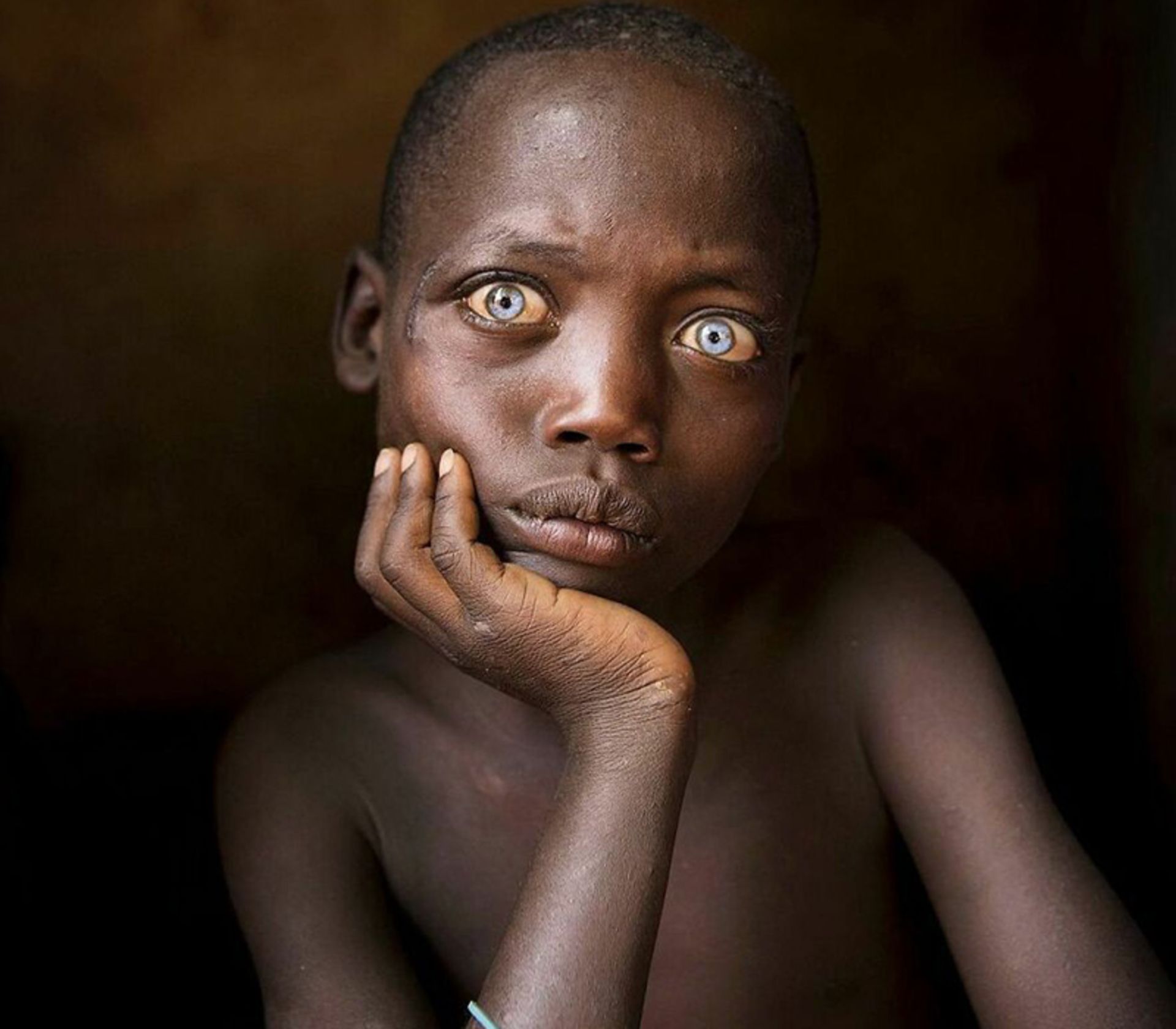 کودک آفریقایی با چشم زاغ
